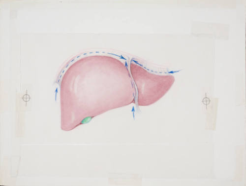 Divising suspensory ligaments of liver (liver transplant donor operation)